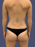 Liposuction 6 - Posterior Flanks After